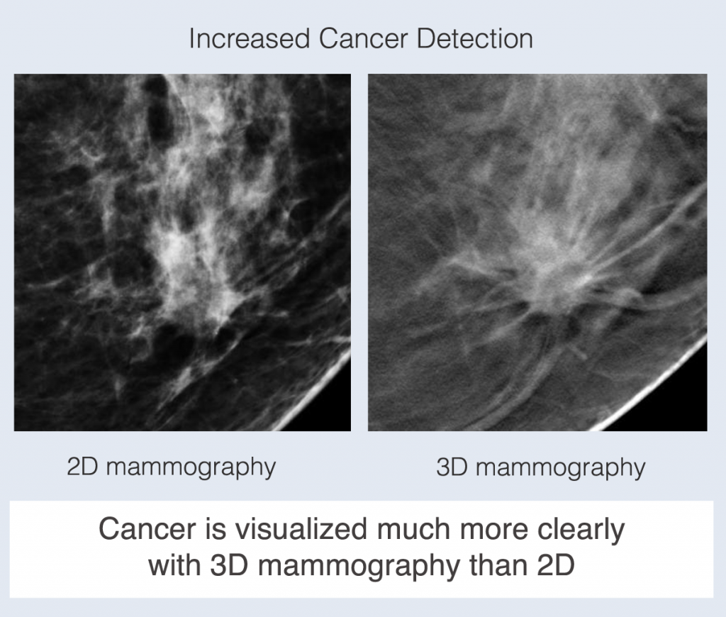 3D Screening Mammography | Wake Radiology UNC REX