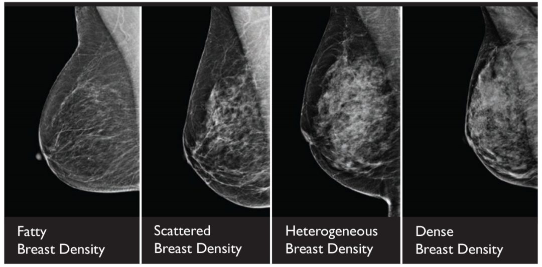 What Does It Really Mean To Have Dense Breasts? | Wake Radiology